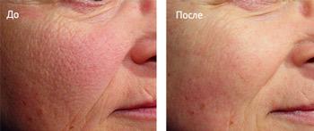 Фракционное лазерное омоложение кожи лица — особенности процедуры