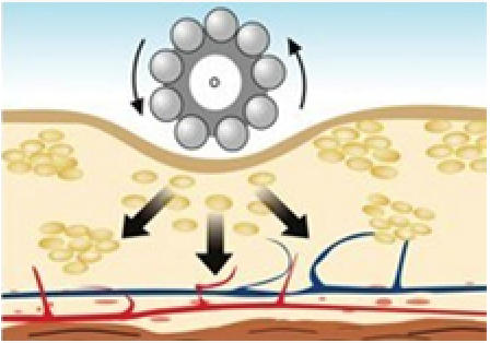 За счет стимуляции механорецепторов в коже («частицы Меркель») жирные кислоты распадаются, запускается процесс похудения.